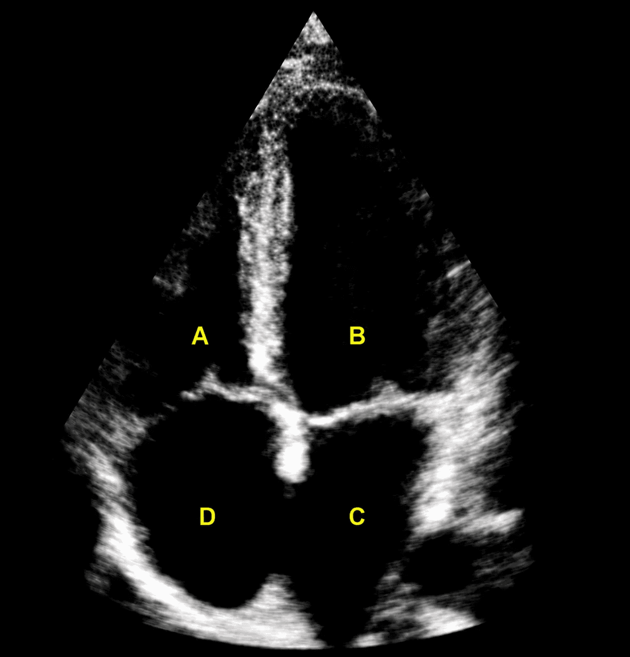 ADVANCED Exam apical four-chamber echocardiogram question preview